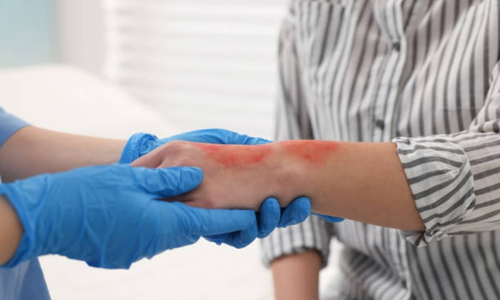 Frequent Causes of Burn Injuries in Texas